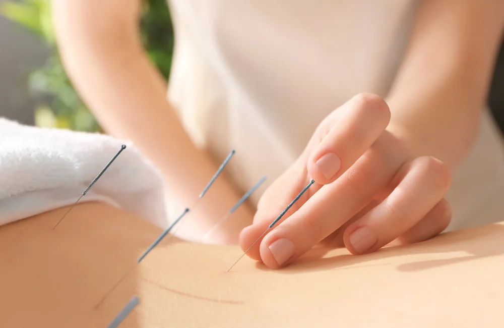 What is Acupuncture